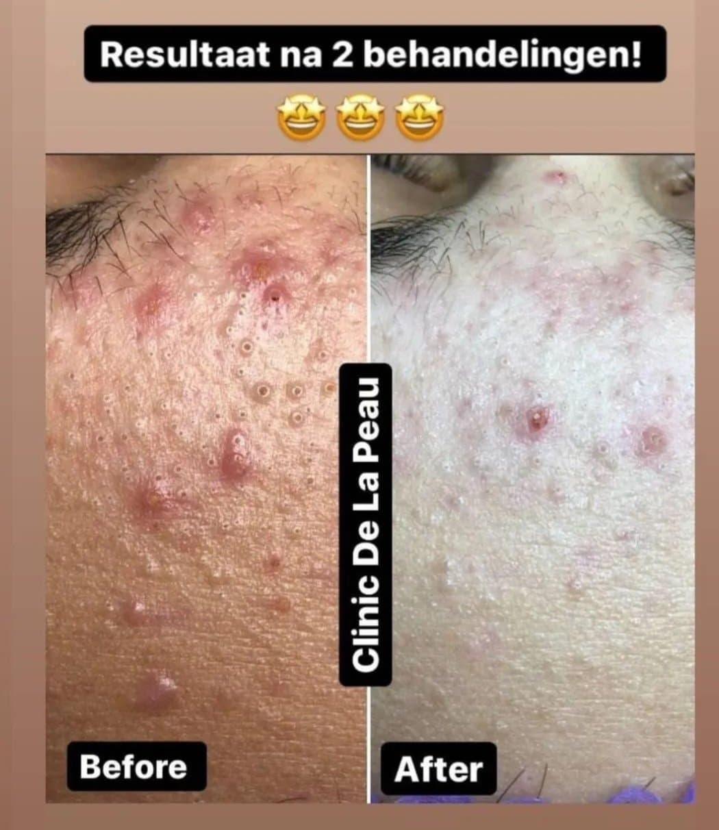 Voor en na een acnebehandeling, resultaat na twee behandelingen