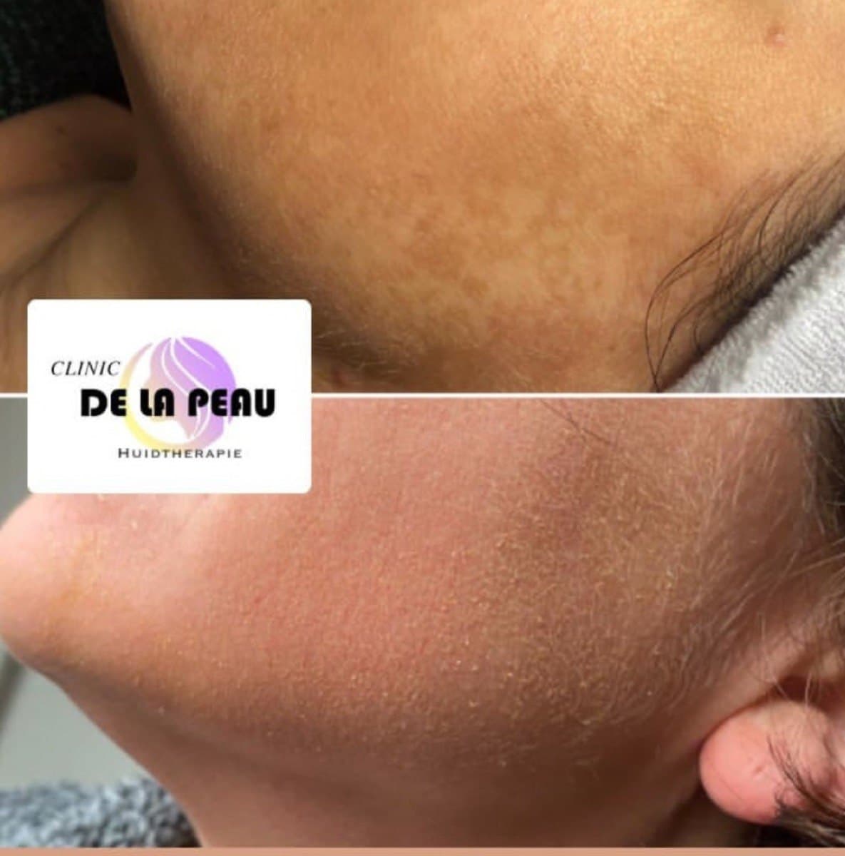 Voor en na een pigmentbehandeling bij Clinic De La Peau