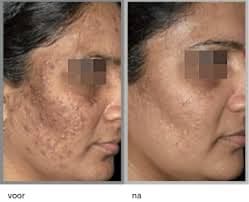 Voor en na een medische peeling tegen pigment